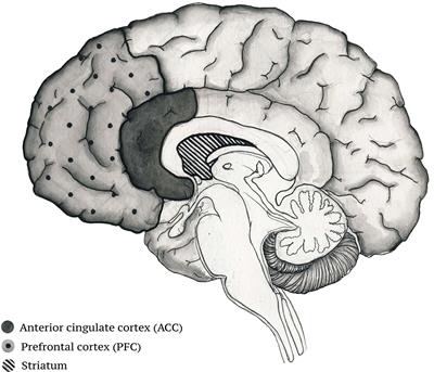 A Complex Combination Therapy for a Complex Disease–Neuroimaging Evidence for the Effect of Music Therapy in Schizophrenia